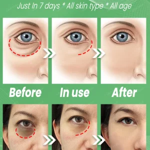 eye bags and dark circles